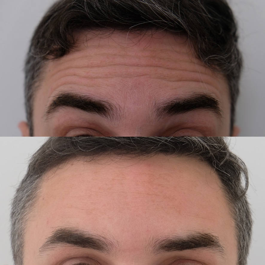 Botox before and after result showing smoother, more relaxed appearance