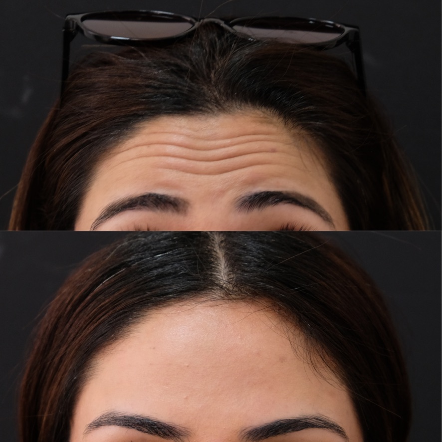Forehead lines before and after Botox treatment