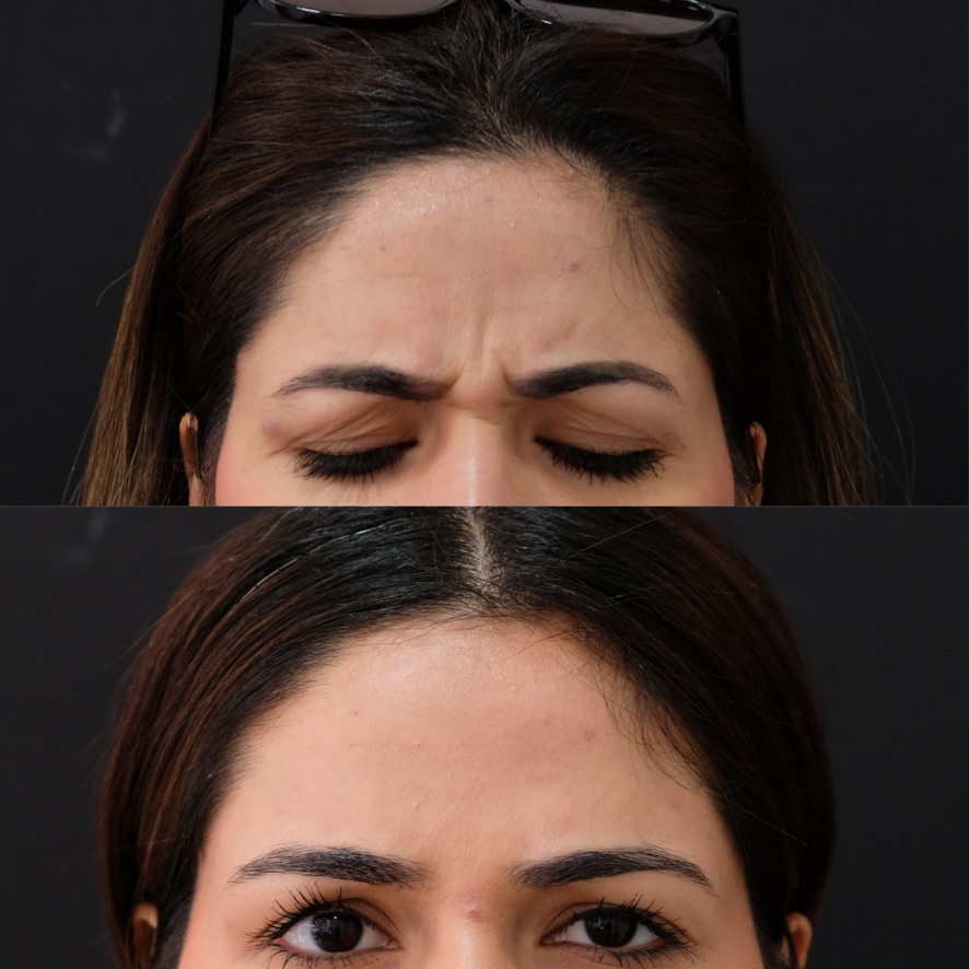 Frown lines before and after Botox treatment