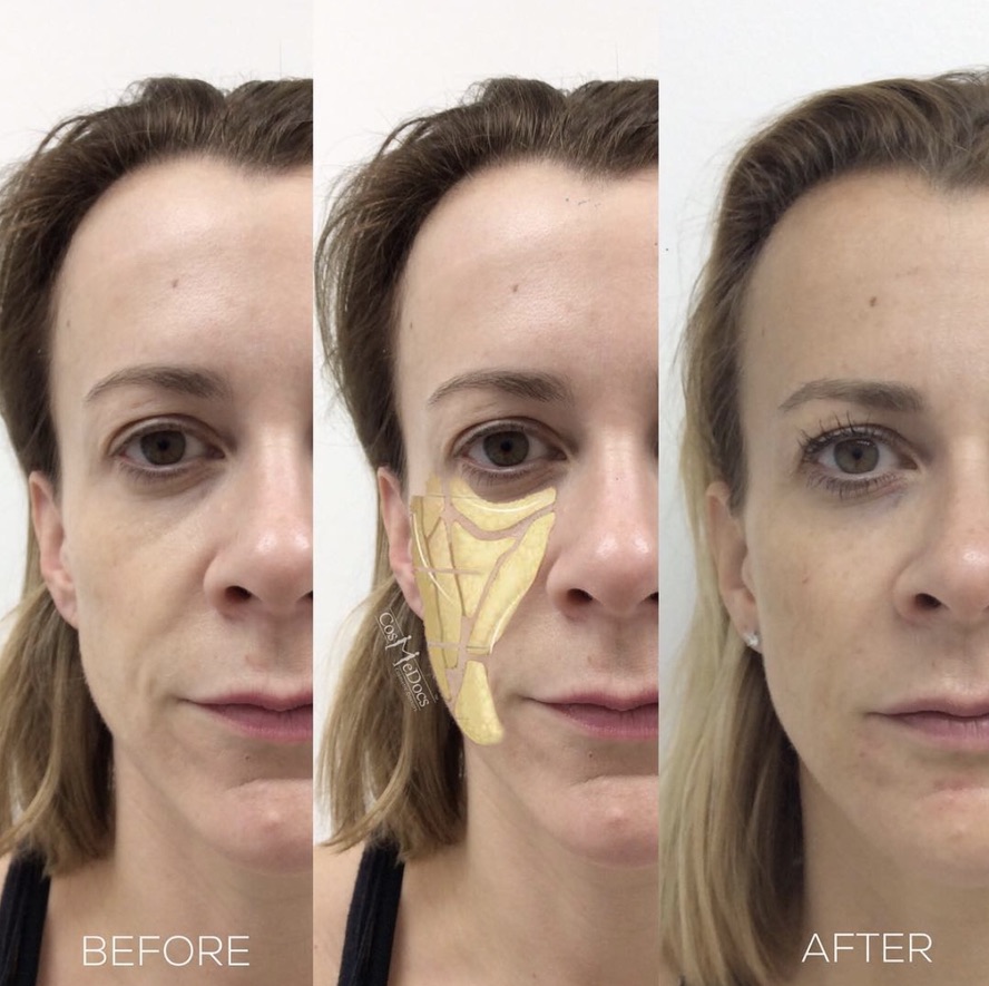 Full-face dermal filler before and after showing facial rejuvenation