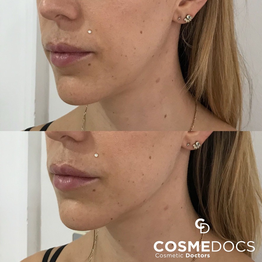 Before and after jawline filler showing improved lower face contour and definition