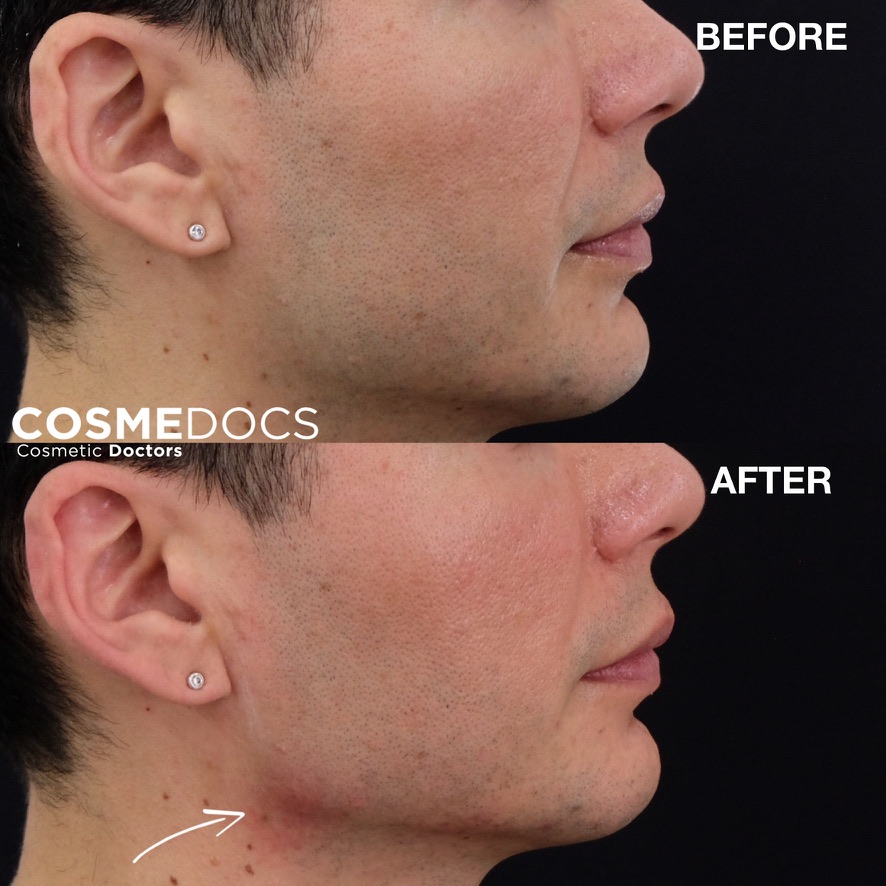 Before and after jawline filler demonstrating enhanced jaw angle and profile