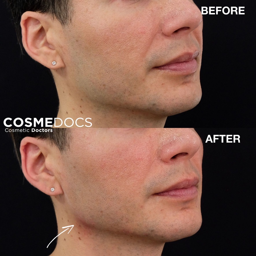 Before and after jawline filler showing sharper jaw angles