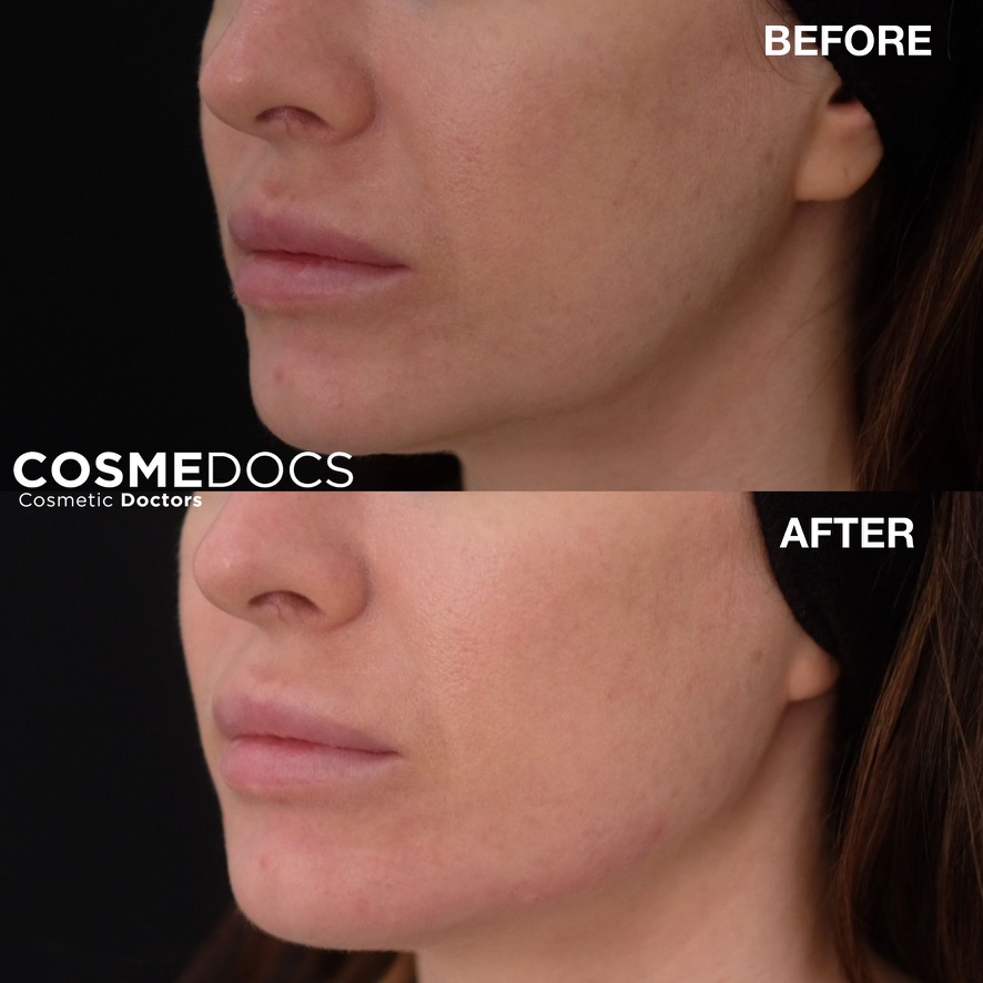 Before and after jawline filler demonstrating lower face refinement