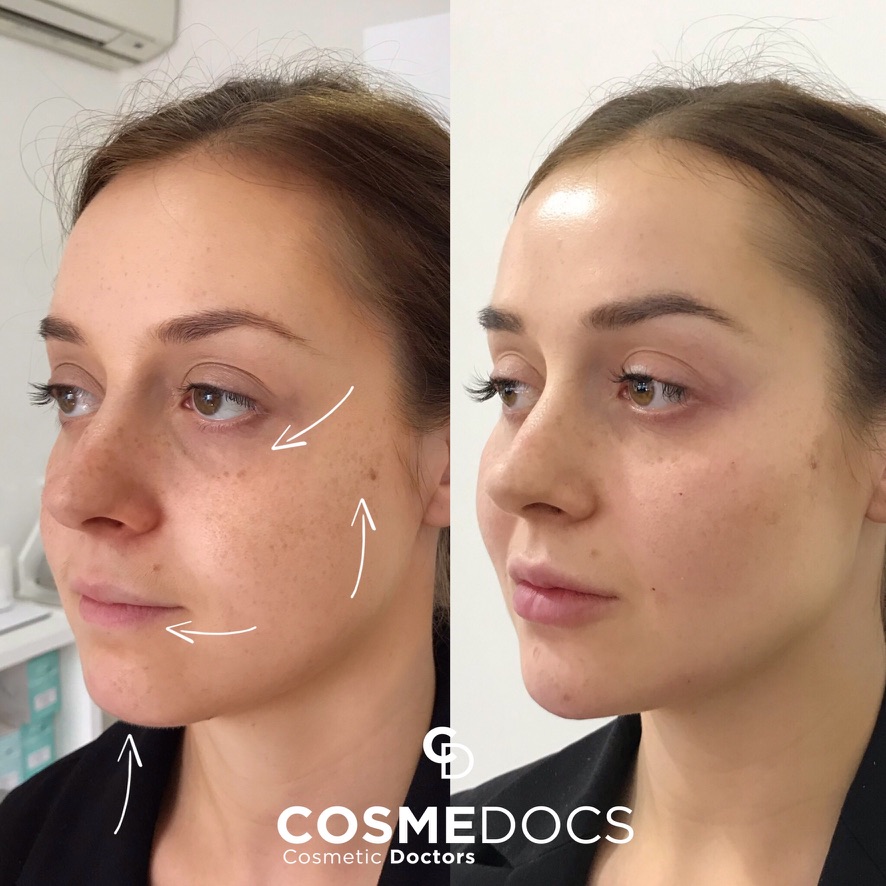 Cheek and full face filler restoration result