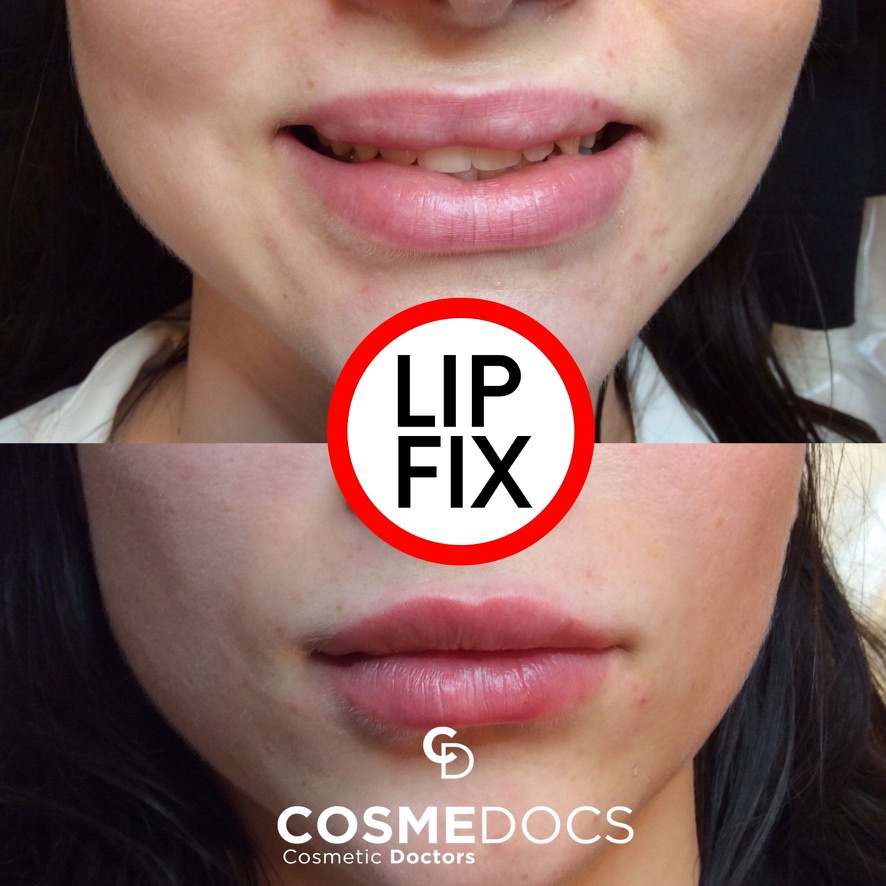 Lip filler correction — over-filled lips dissolved and re-shaped