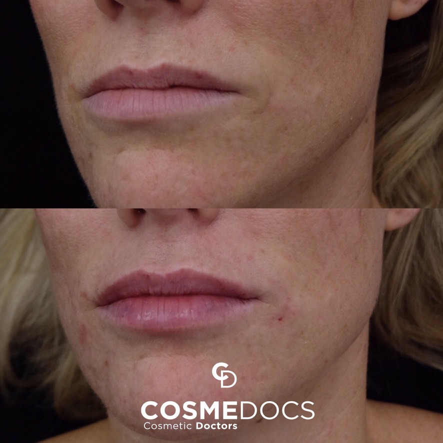 Before and after lip filler showing natural volume enhancement