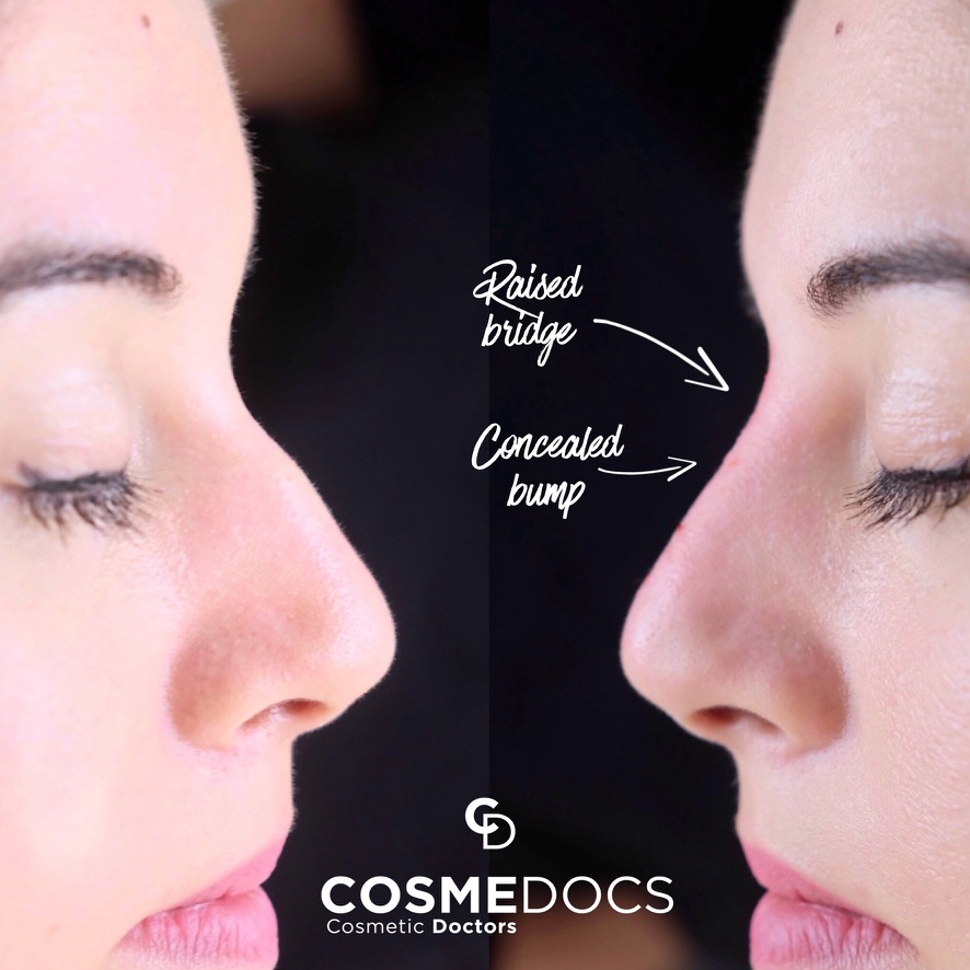 Before and after non-surgical nose job showing bridge refinement and profile improvement