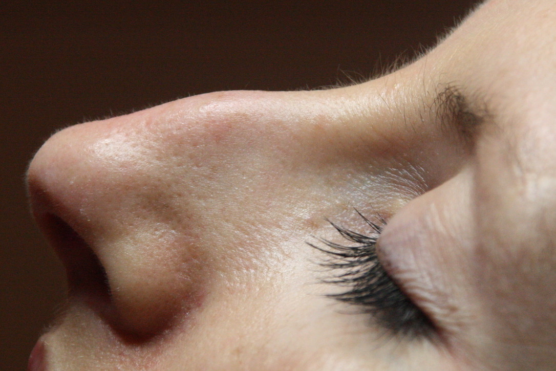 Large nose with prominent dorsal bump before non-surgical rhinoplasty treatment