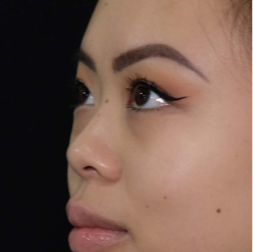 Asian nose reshaping before treatment showing flat nasal bridge profile