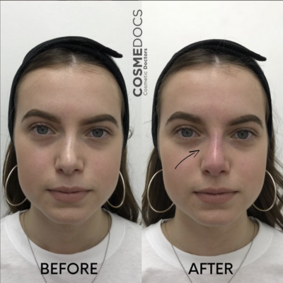 Frontal nose contour correction before and after non-surgical rhinoplasty