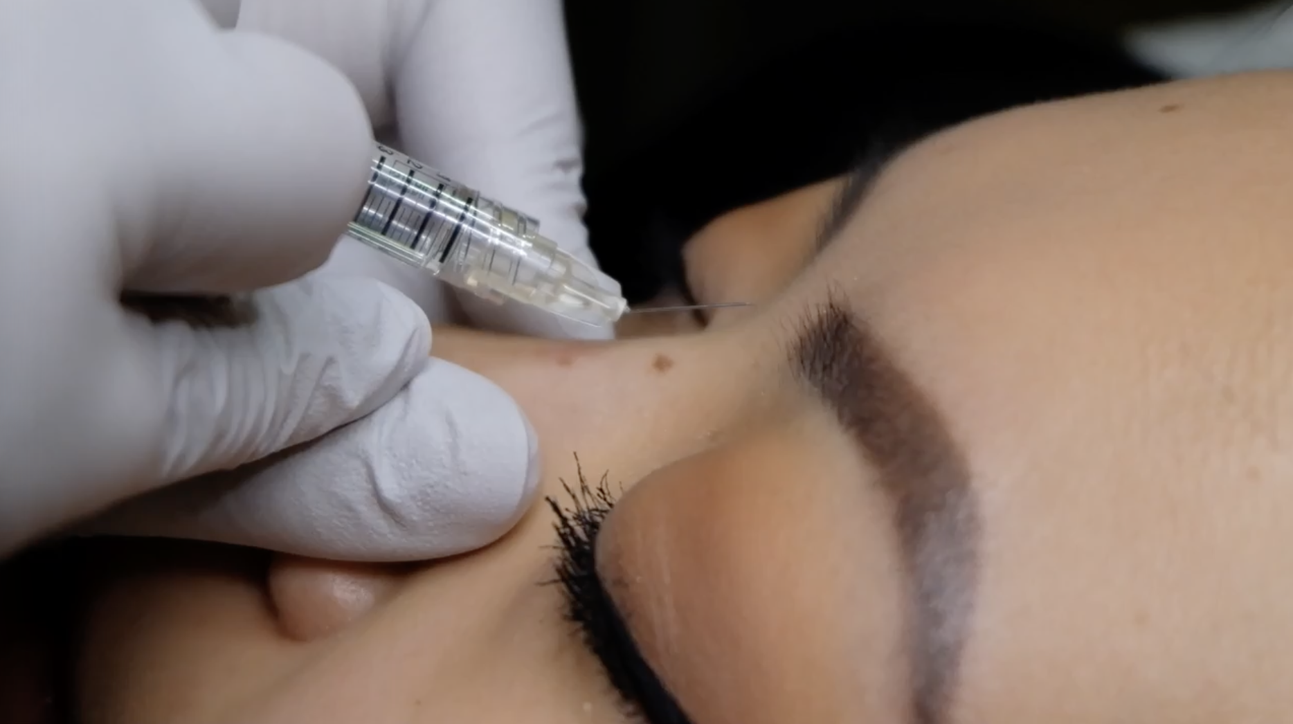 Cannula nose filler procedure at Cosmedocs, Harley Street