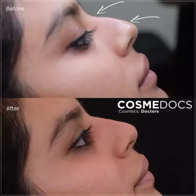 Non-surgical nose tip lifting before and after with directional arrows showing improvement