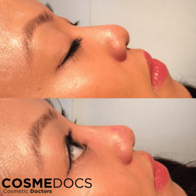 Close-up nose tip lift before and after showing refined nasal tip
