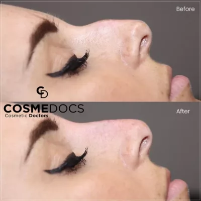 Subtle nose tip lift before and after non-surgical rhinoplasty