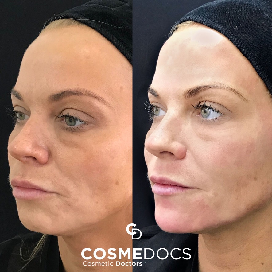 Before and after full face makeover showing restored facial balance and proportion