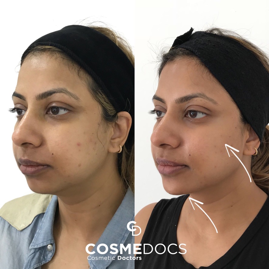 Before and after full face makeover showing improved jawline definition and mid-face lift