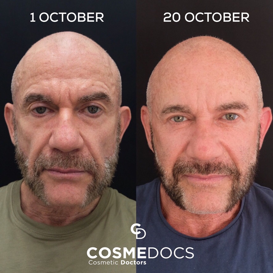 Before and after full face makeover showing male full-face rejuvenation