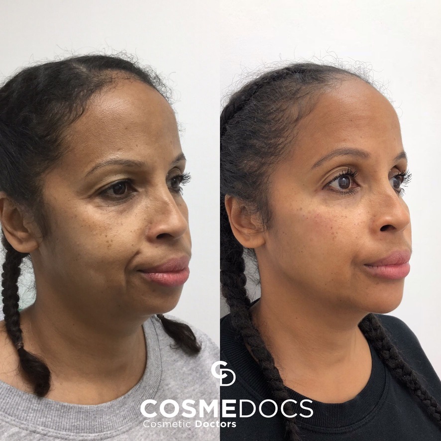 Before and after full face makeover showing natural facial balance and harmonious results