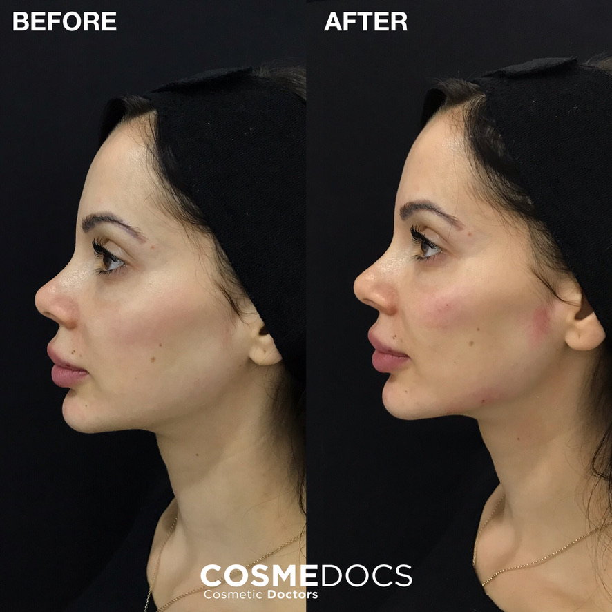 Before and after full face makeover profile view showing chin and jawline enhancement