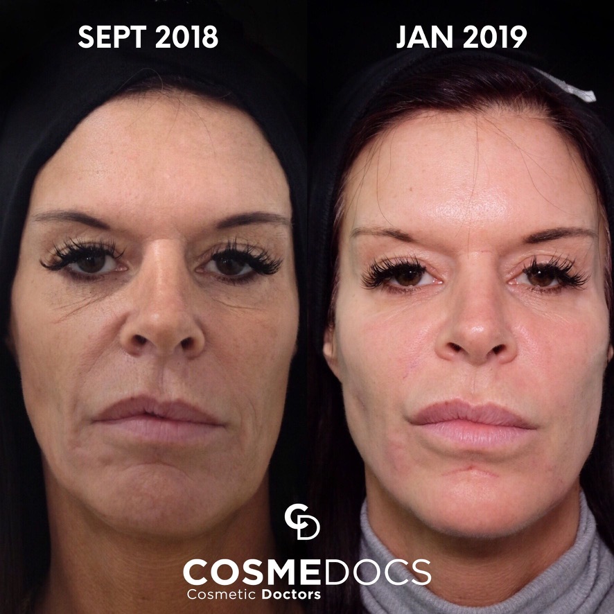 Before and after full face makeover showing volume restoration over several months