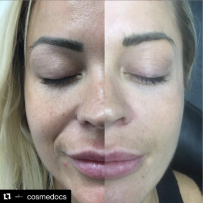 Effective melasma treatment utilising microneedling, prescription skincare, and chemical peel techniques