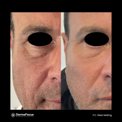 Before and after photos of a male face, showing the effects of polynucleotide treatments on skin texture and under-eye area, with visible improvement in smoothness and reduced wrinkles.