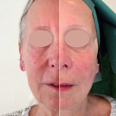 Thread face lift before and after showing natural facial rejuvenation