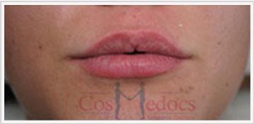 Lips Treatment Procedure After