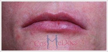 Derma Filler Wode lips Treatment After