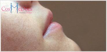 Lip Enhancement with Darma Filler Treatment After