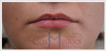 Lips Treatment Procedure before