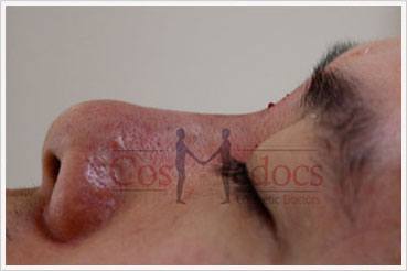 Non Surgical Nose Job Treatment After