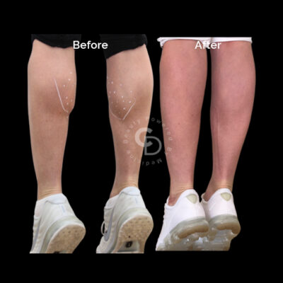Calf slimming Botox before and after showing proportionate lower legs