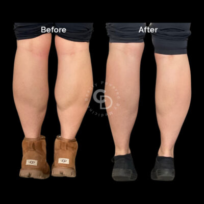 Calf reduction treatment results showing refined leg silhouette