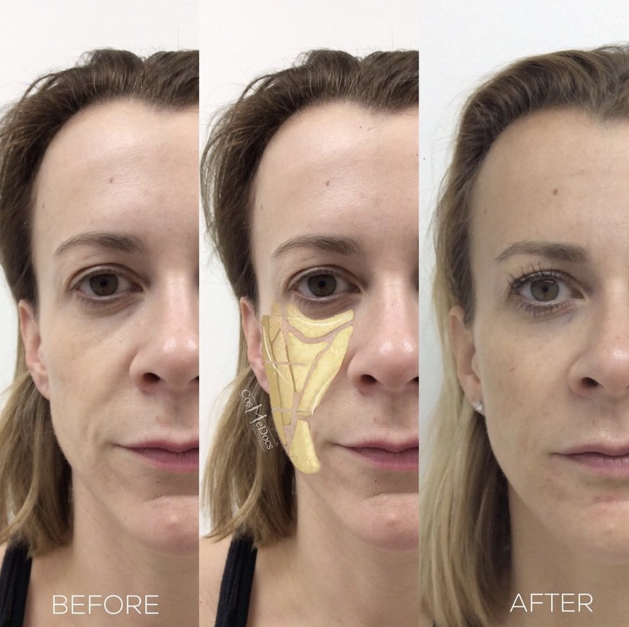 Before and after HA Makeover showing full-face rejuvenation with anatomical planning
