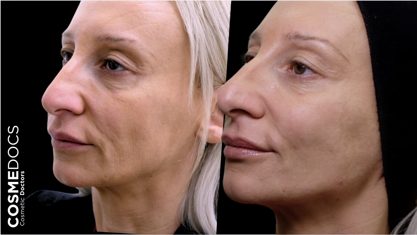 PDO thread lift before and after showing natural facial lifting and tightening