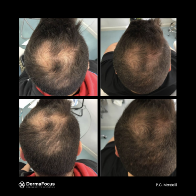 Polynucleotide scalp hair restoration before and after