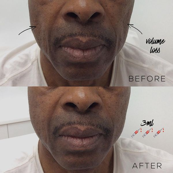 Before and after cheek volume restoration addressing hollow cheeks