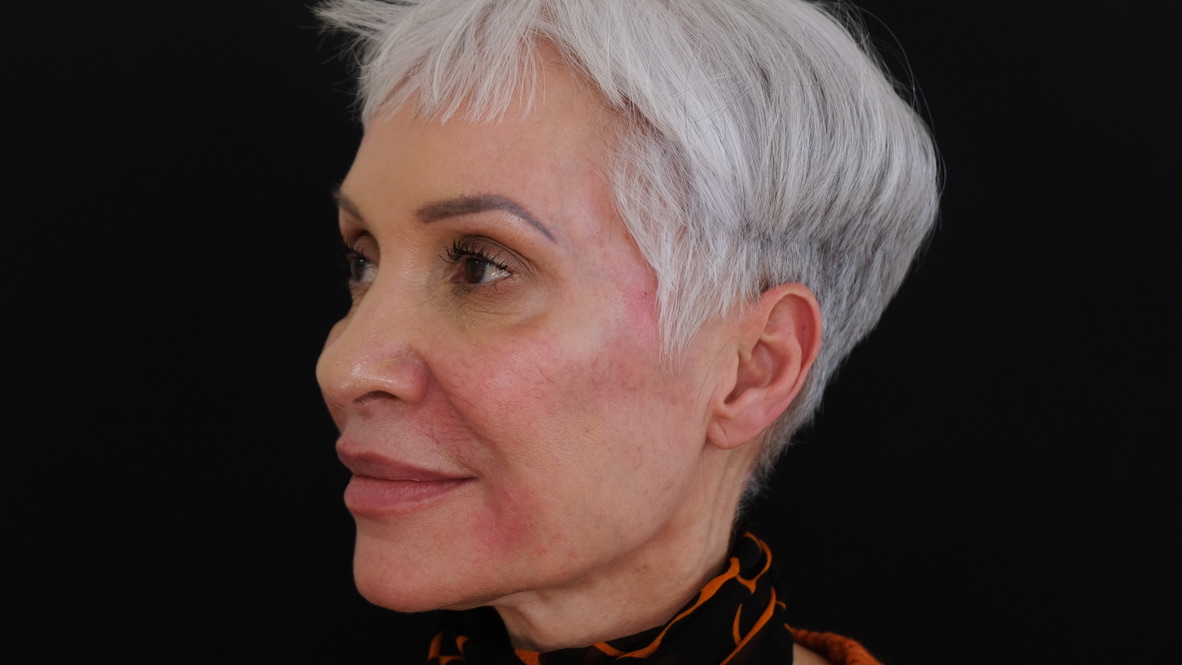 Before and after temple filler showing restored volume and improved facial contour