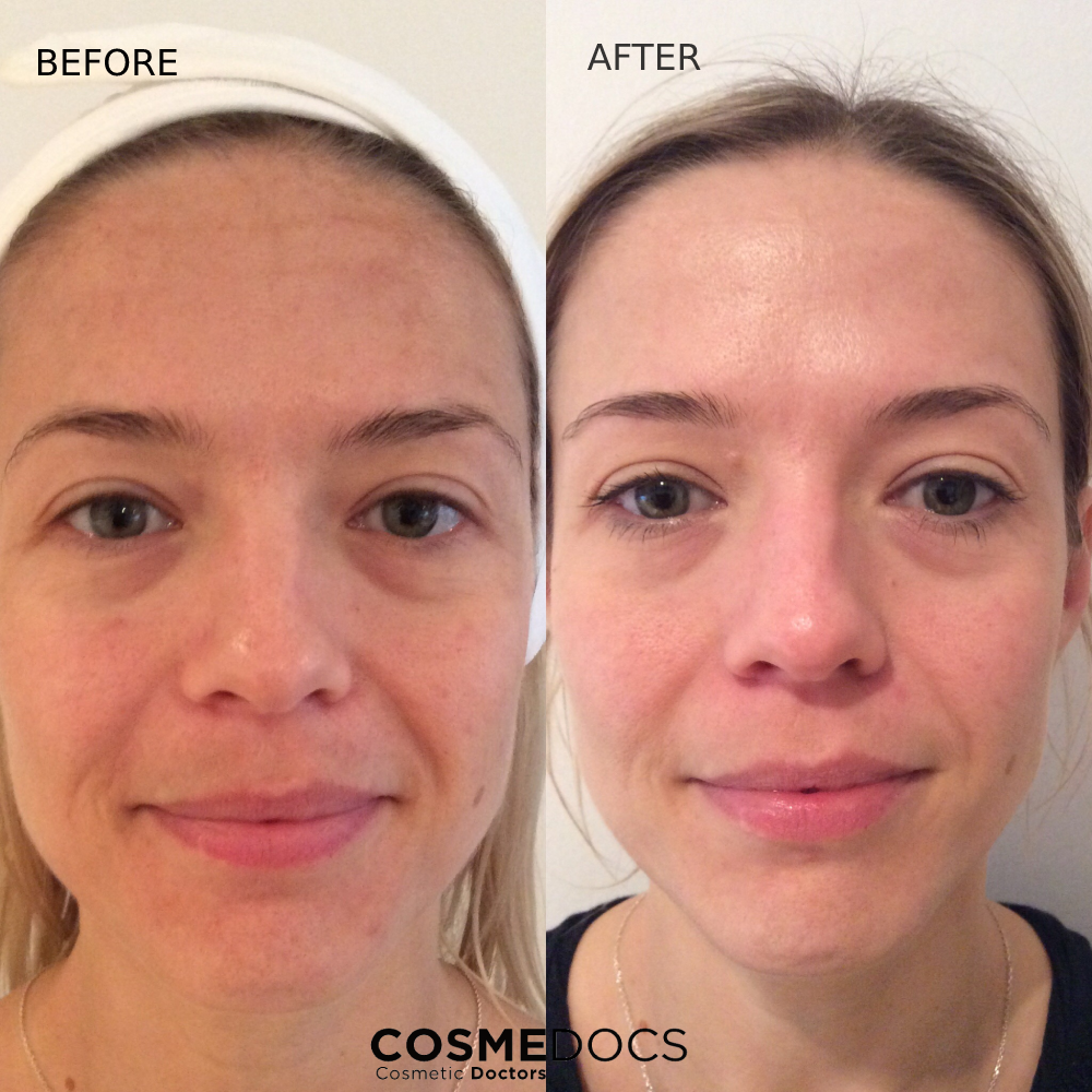 Chemical peel before and after skin improvement
