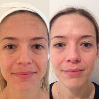 HydraFacial complexion enhancement before and after