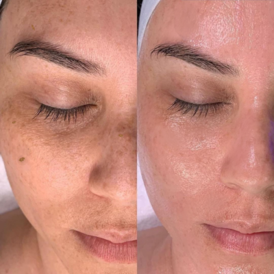 HydraFacial pigmentation treatment before and after