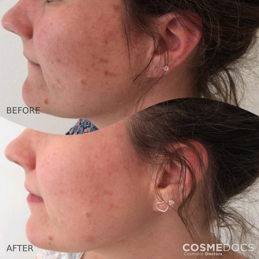 Chemical peel profile view results