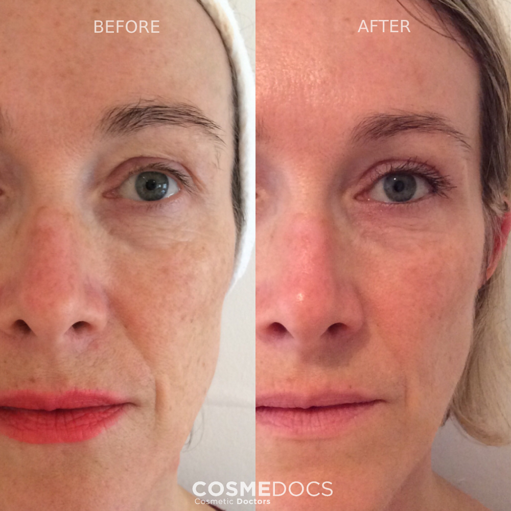 Chemical peel eye area treatment results