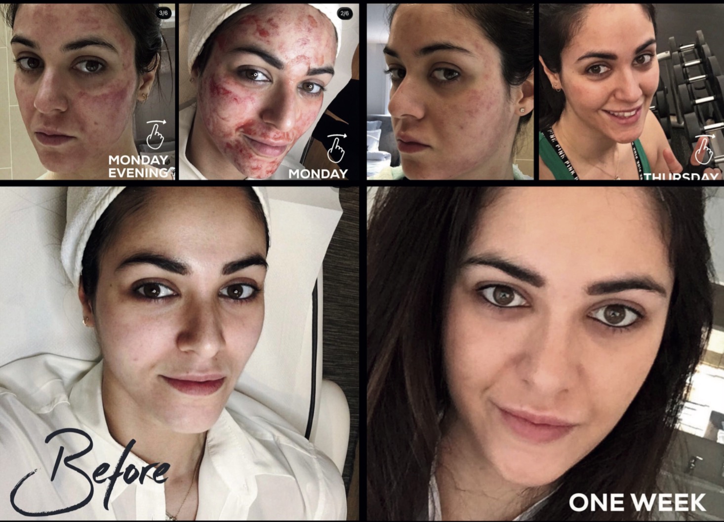 Microneedling 7-day transformation journey showing progressive healing