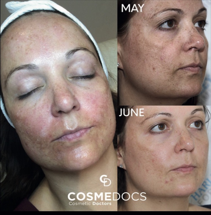 Combined microneedling and chemical peel treatment results