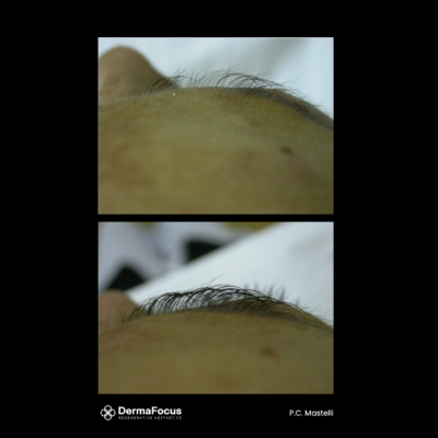 Polynucleotide eyebrow area treatment before and after