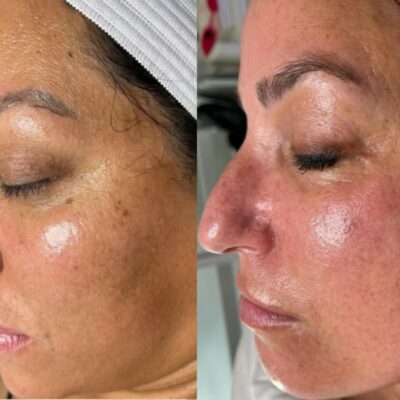 HydraFacial skin hydration before and after
