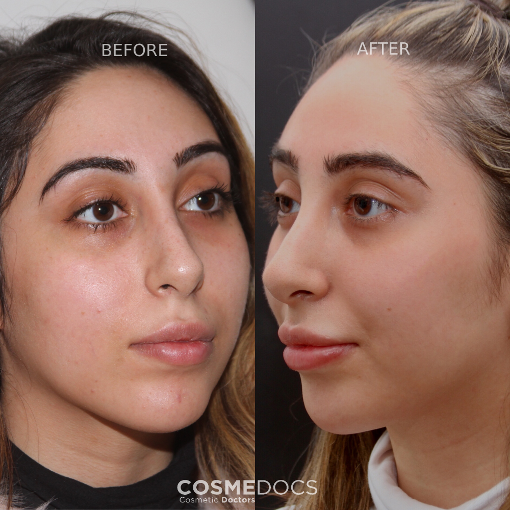 Chemical peel skin rejuvenation results